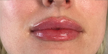 Lip Filler Before and After Photo by Coachlight Clinic & Spa in West Des Moines Iowa