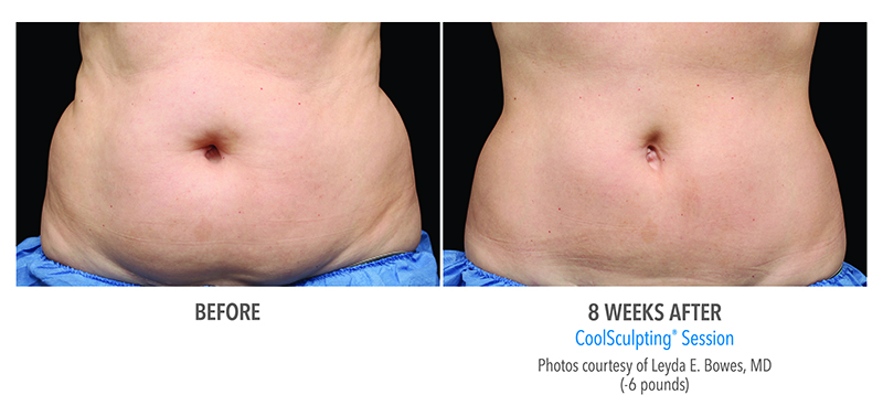 Just Freeze It! 3 Coolsculpting In Abdomen Before And After Photo In Des Moines And Ankeny, Iowa