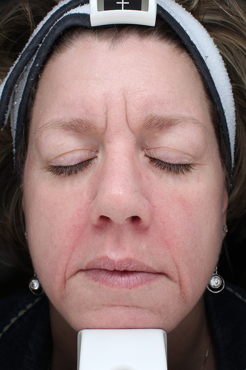 Summer Glow With Halo Pro After Photo By Coachlight Clinic &Amp; Spa In Des Moines And Ankeny, Iowa