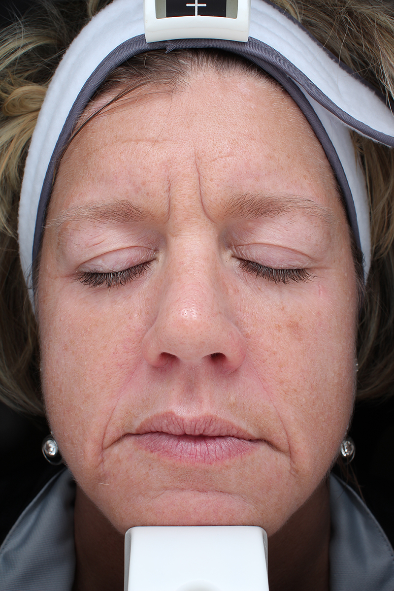 Summer Glow With Halo Pro Before Photo By Coachlight Clinic &Amp; Spa In Des Moines And Ankeny, Iowa