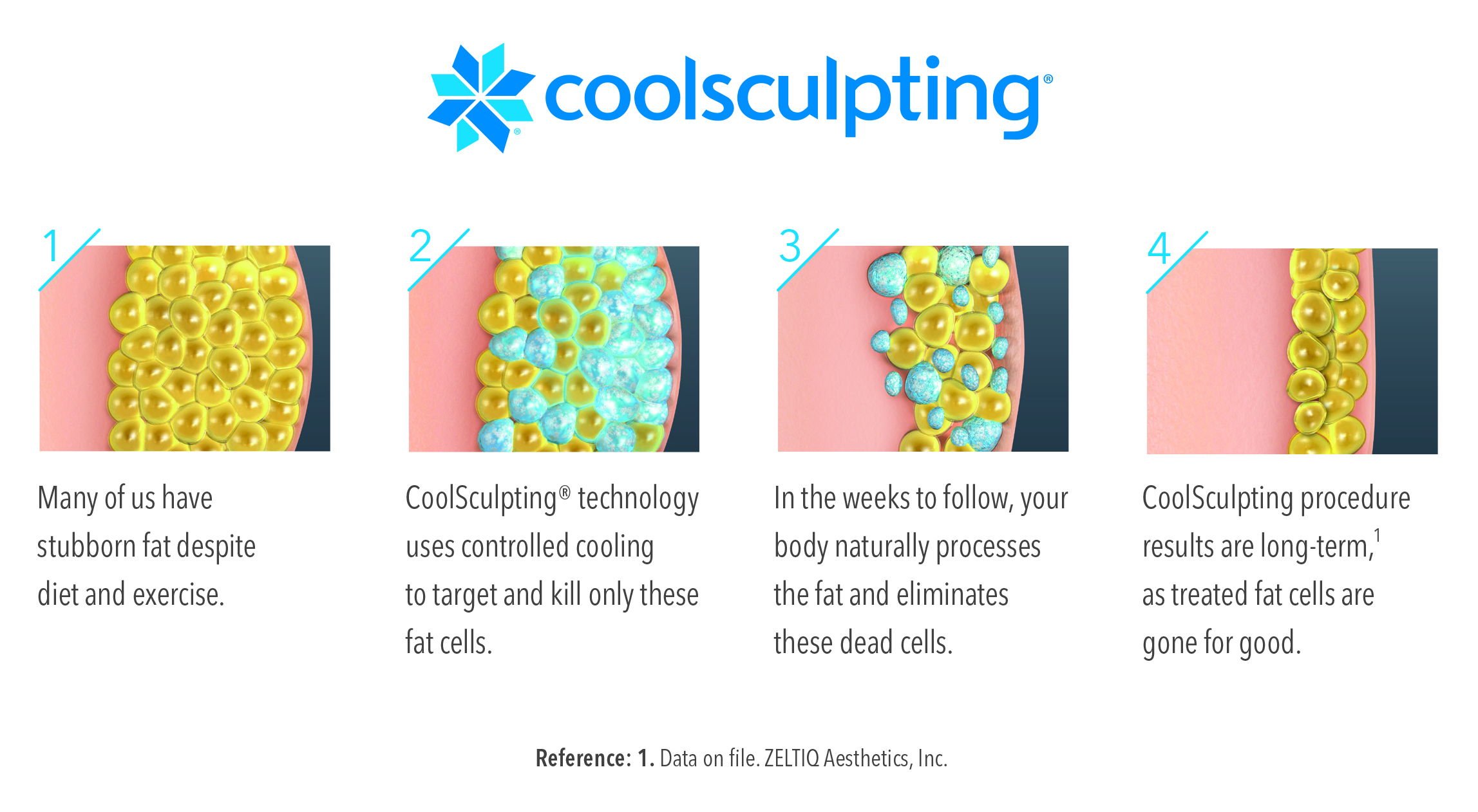 Just Freeze It! 2 Coolsculpting Illustration