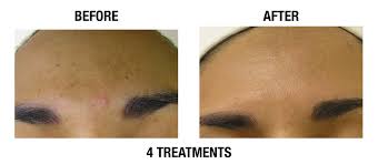 Hydrafacial Before And After Photo By Coachlight Clinic &Amp; Spa In Des Moines And Ankeny, Iowa