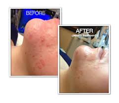 Hydrafacial Before And After Photo By Coachlight Clinic &Amp; Spa In Des Moines And Ankeny, Iowa