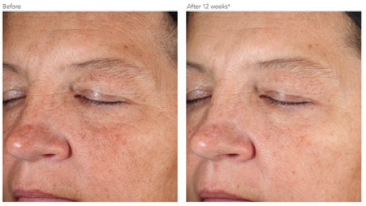 D·e·j Face Cream™ Before And After Photo In Des Moines And Ankeny, Iowa