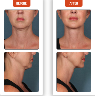 Kybella Before And After Photo In Des Moines And Ankeny, Iowa