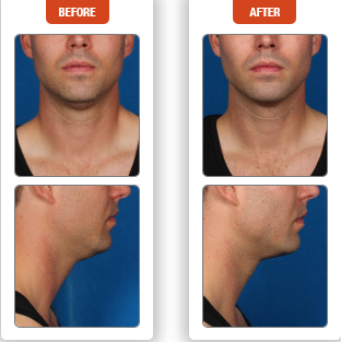 Kybella Before And After Photo In Des Moines And Ankeny, Iowa