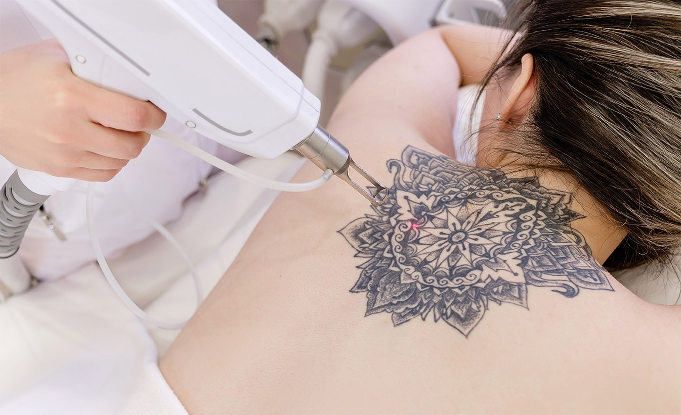 Top View Hand Of A Beautician Holds A Laser Device Over A Tattoo