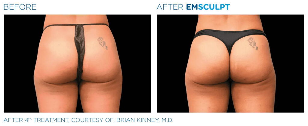 Emsculpt Buttocks Female Before And After