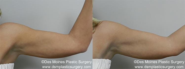 Exilis Before And After Photo