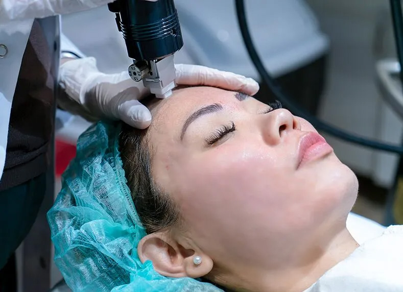 Intracel Microneedling Procedure
