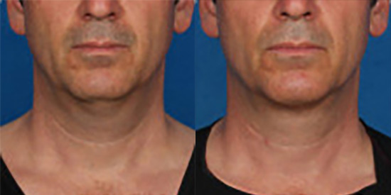 Kybella Before After Man Photo