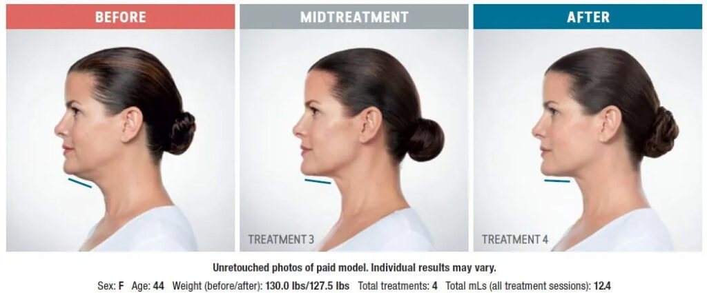 Kybella Before And After Diagram
