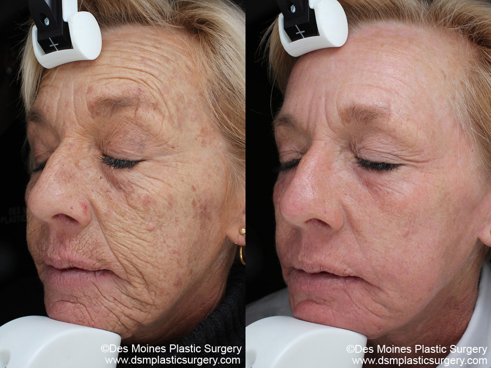Laser Resurfacing With Sciton 2 Laser Resurfacing Before And After Photograph