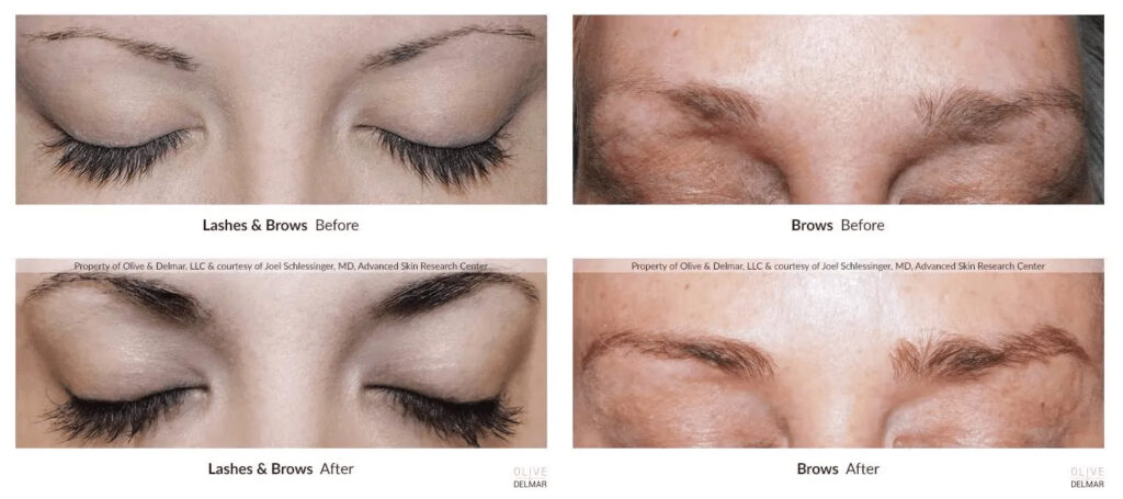Neubrow Pro Before And After Photos