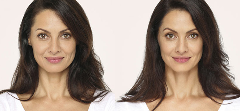 Radiesse Before And After Photograph