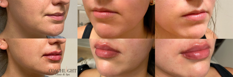 Restylane Kysse Before And After Photograph