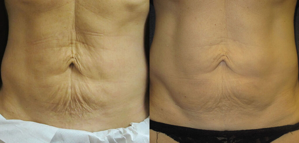 Skintyte Before And After Image