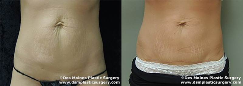 Smartlipo Before After Photograph