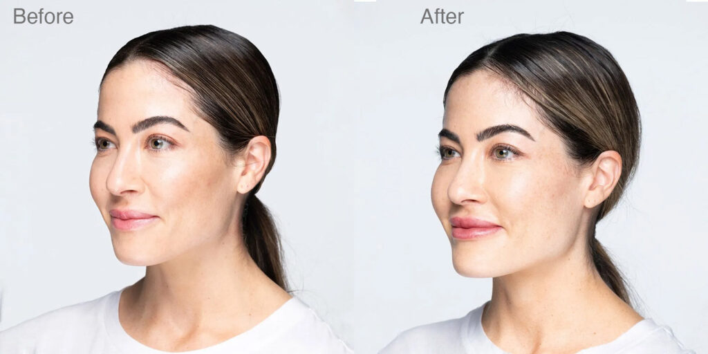 Versa 1 Versa Filler Treatment Before And After