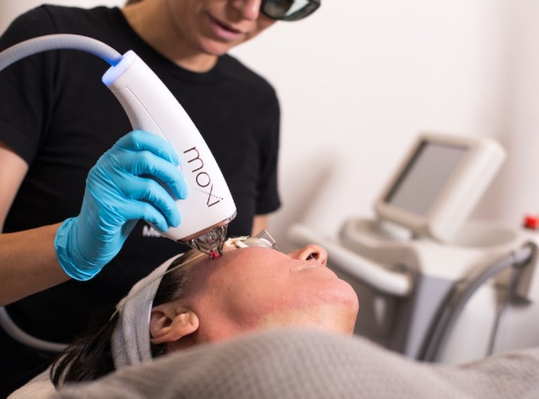 Moxi Laser Treatment X