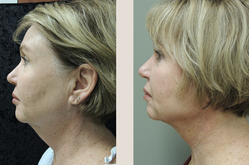 Botox Before And After Photo