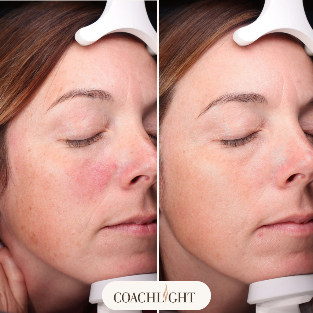 Before And After Laser Treatment