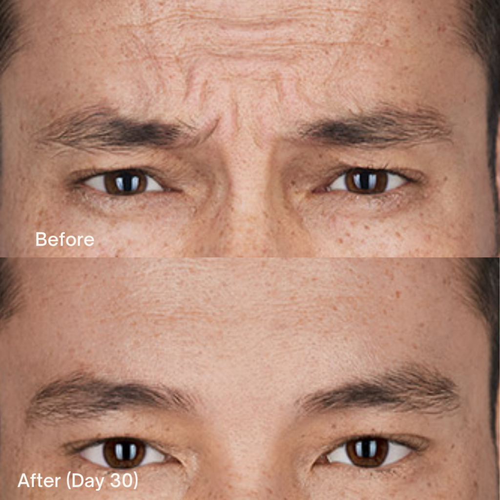 Botox® Cosmetic 7 Botox Before And After