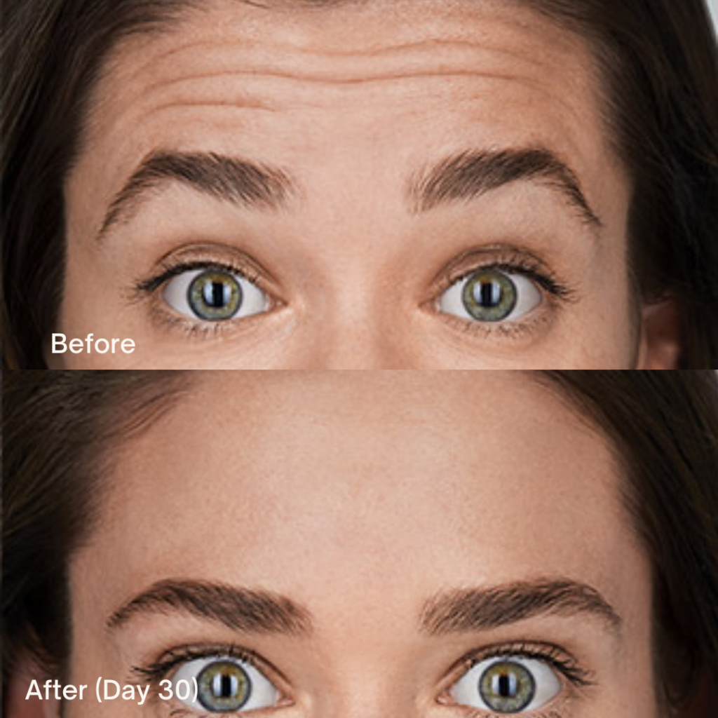 Botox® Cosmetic 3 Botox Before And After