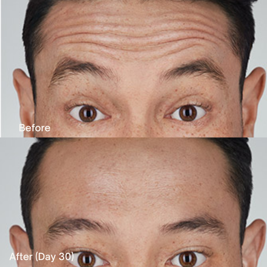 Botox® Cosmetic 6 Botox Before And After