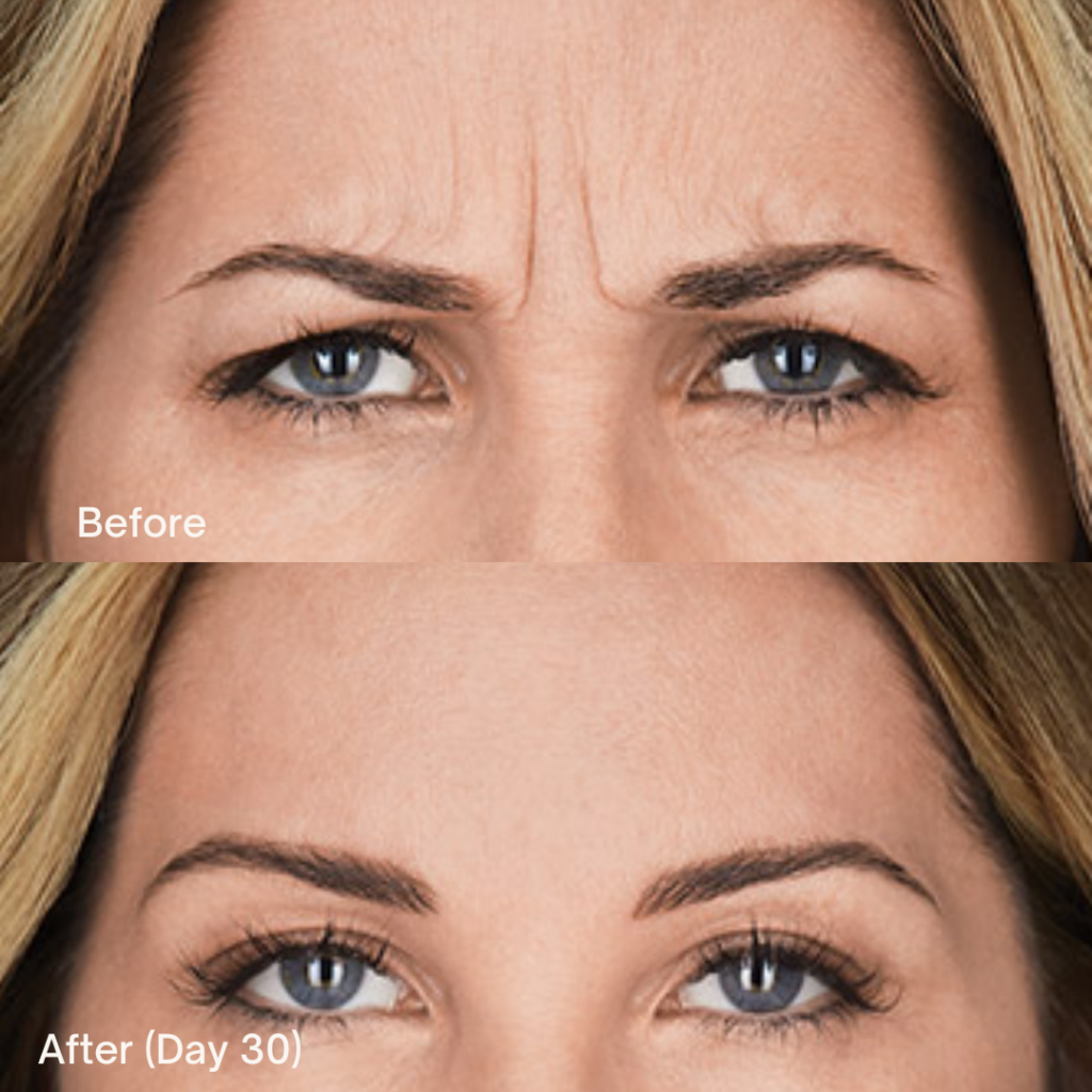 Botox® Cosmetic 8 Botox Before And After
