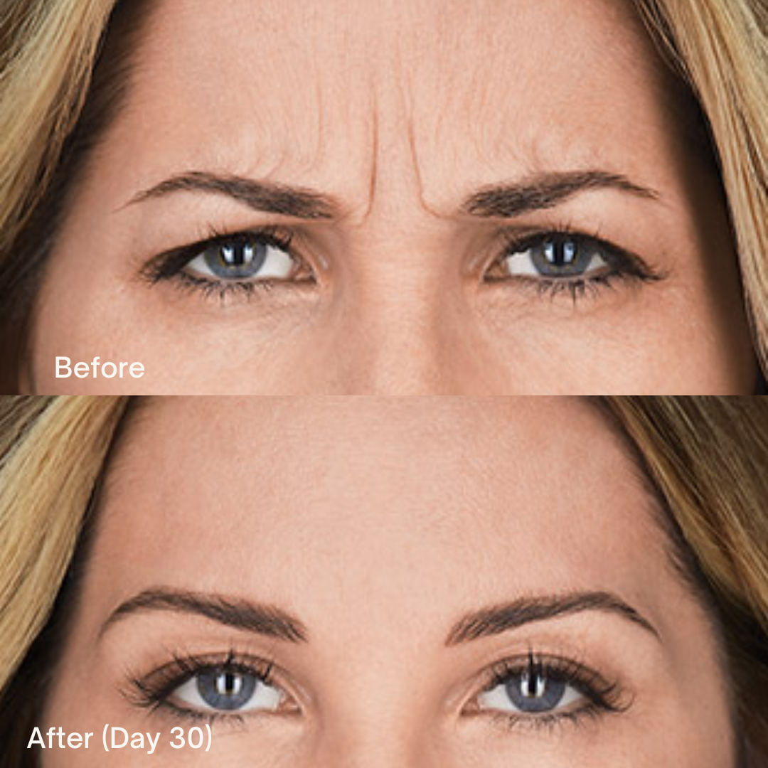 BOTOX Cosmetic in Des Moines, IA | Natural Results | Coachlight Clinic