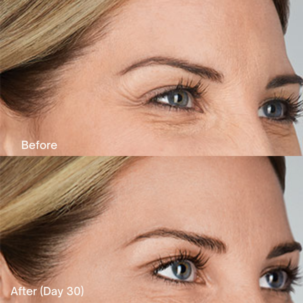 Botox® Cosmetic 9 Botox Before And After