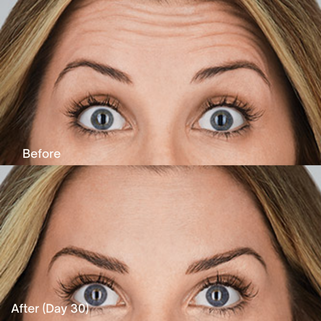 Botox® Cosmetic 10 Botox Before And After
