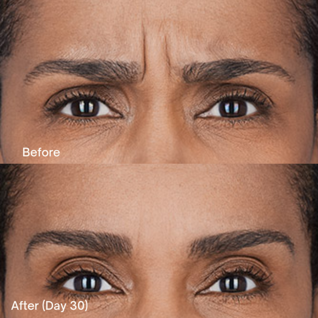 Botox® Cosmetic 11 Botox Before And After