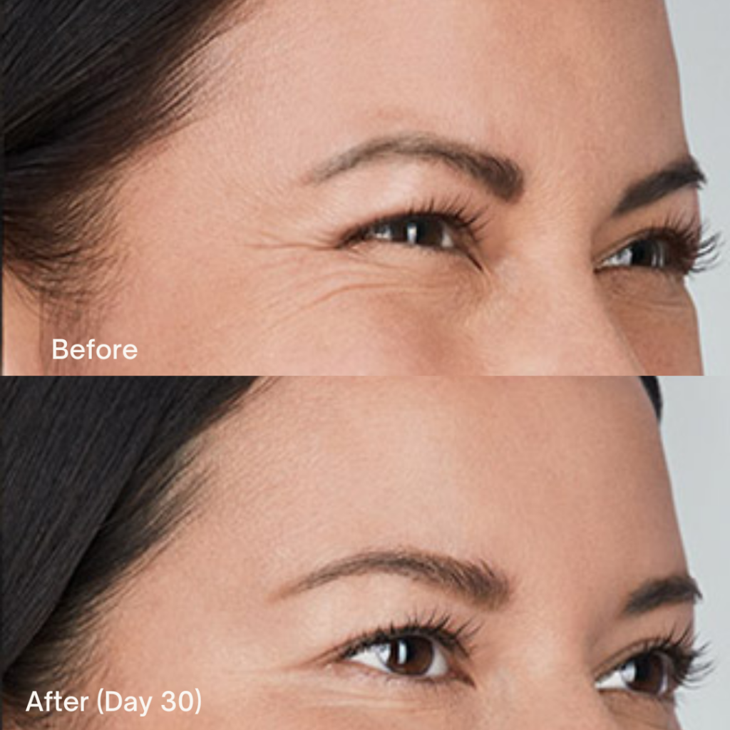 Botox® Cosmetic 12 Botox Before And After