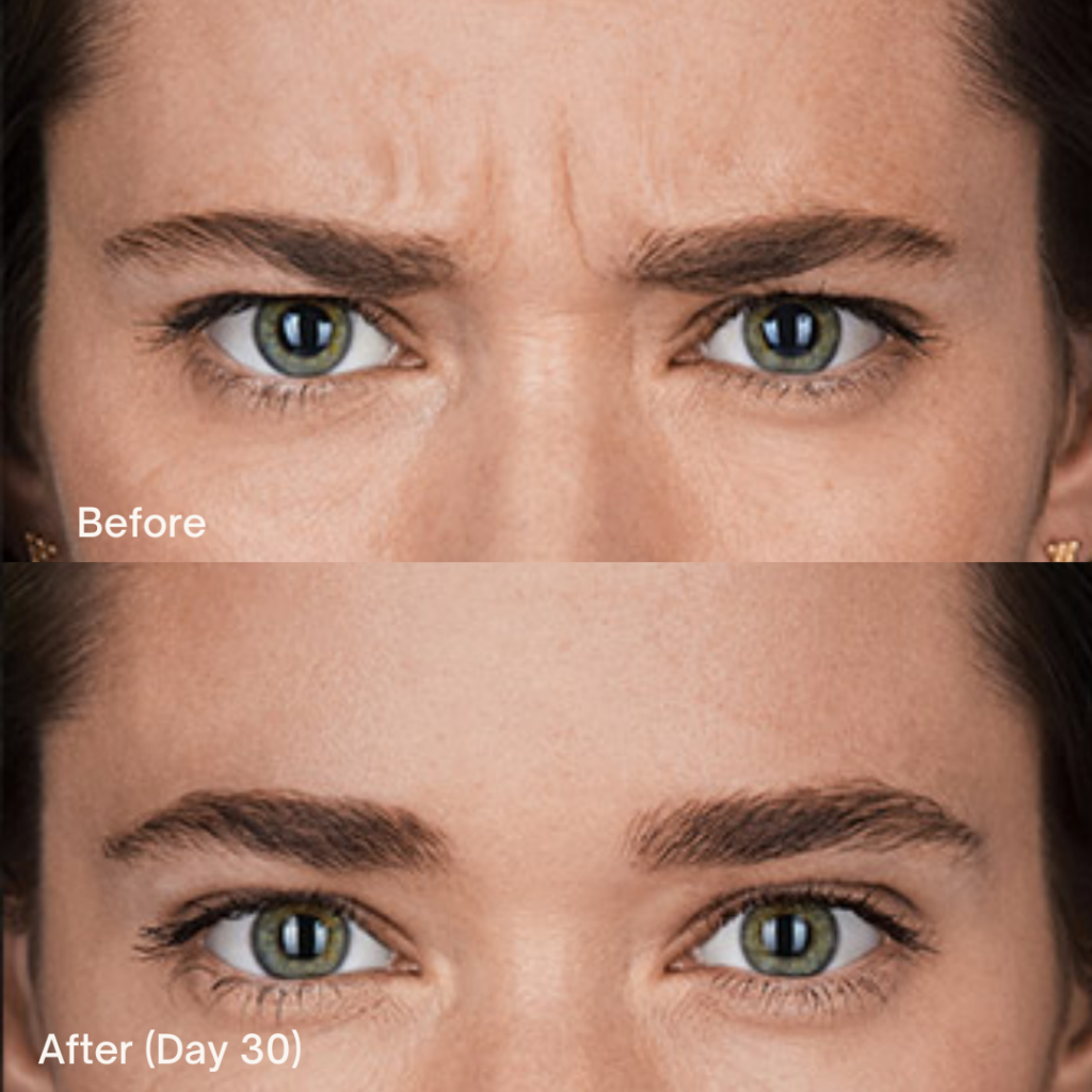 Botox® Cosmetic 4 Botox Before And After