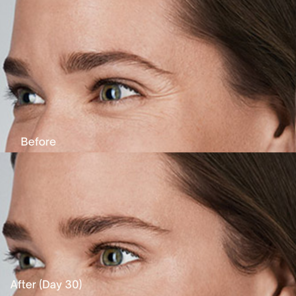 Botox® Cosmetic 5 Botox Before And After
