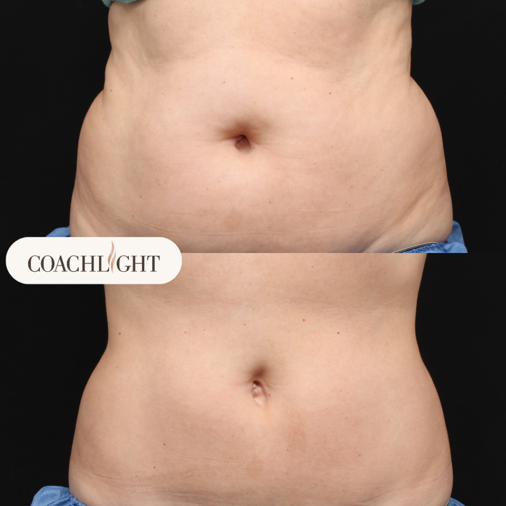 Coolsculpting Before After Stomach Treatment