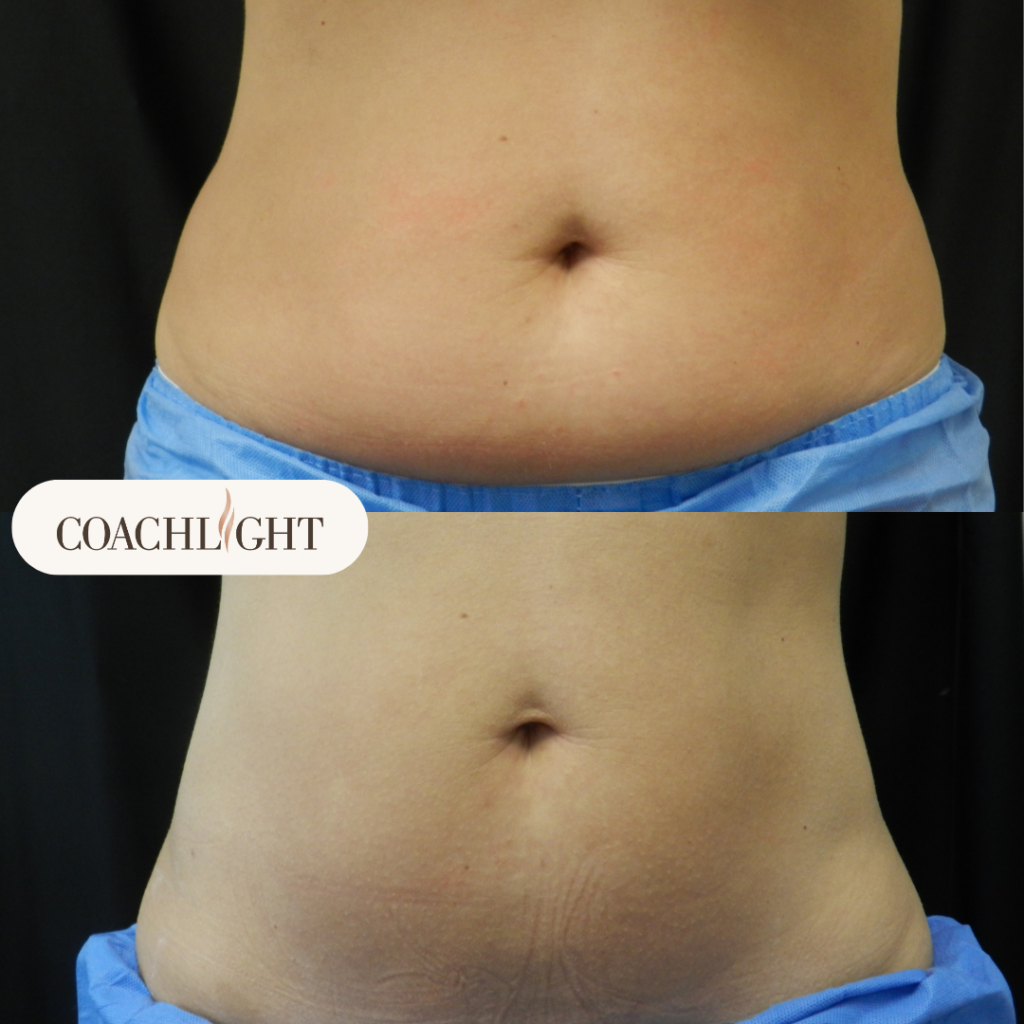 Coolsculpting Before After Stomach Treatment
