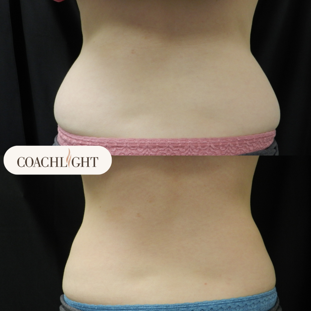 Coolsculpting Before After Back Treatment