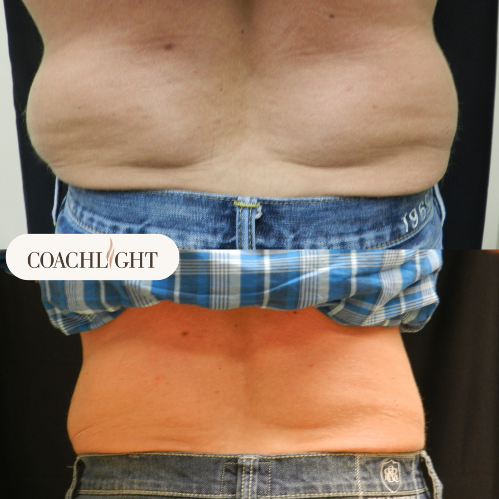 Coolsculpting Before After Back Treatment