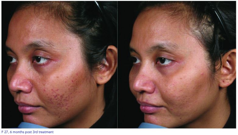 Intracel Microneedling 2 Intracel Before And After