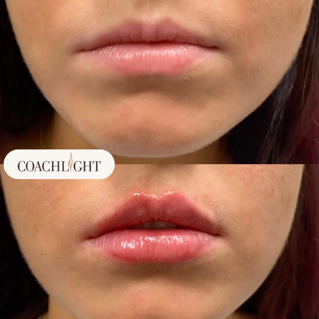 Lip Filler Treatments 3 Lip Filler