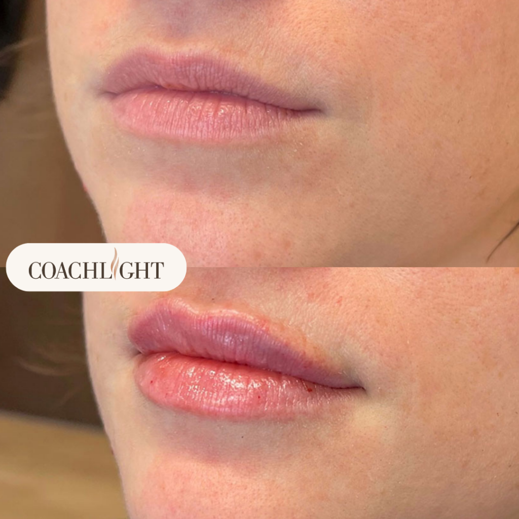 Lip Filler Treatments 4 Lip Filler
