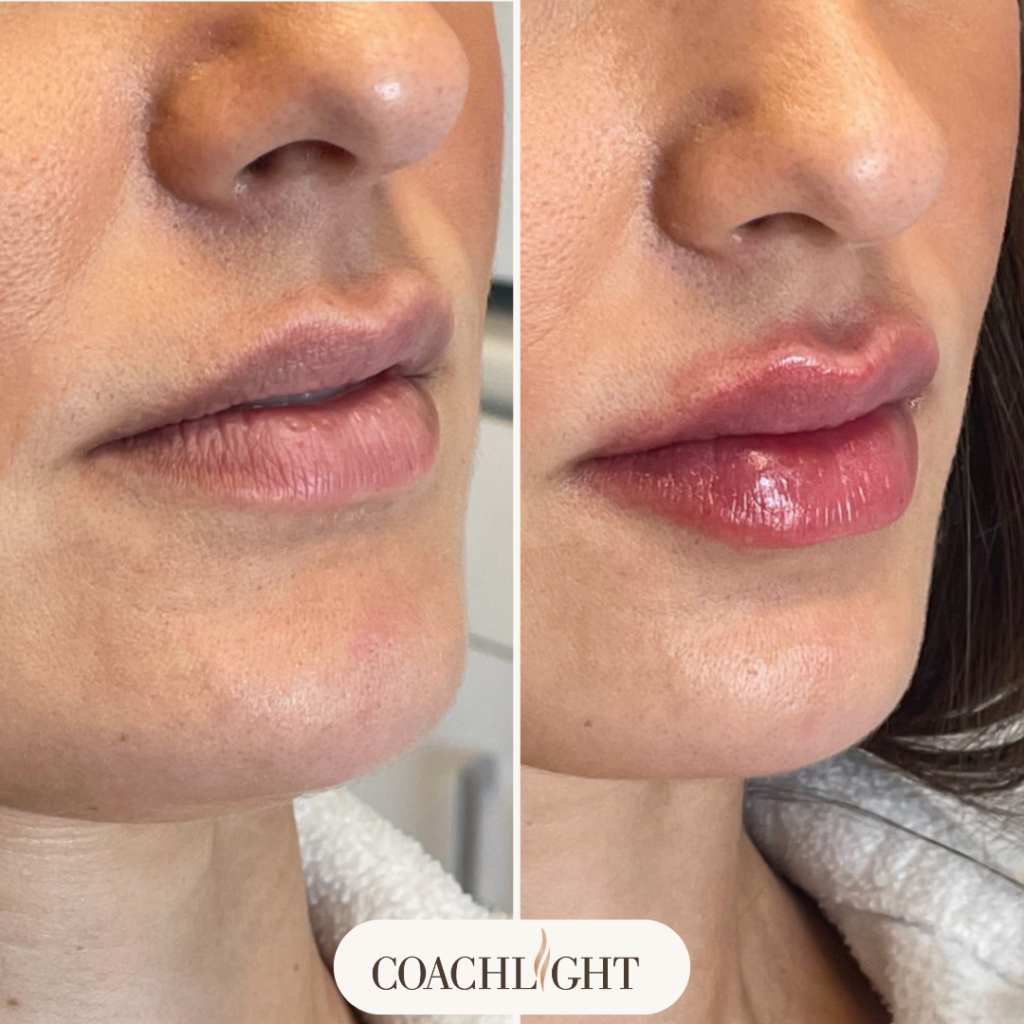 Lip Filler Treatments 2 Lip Filler