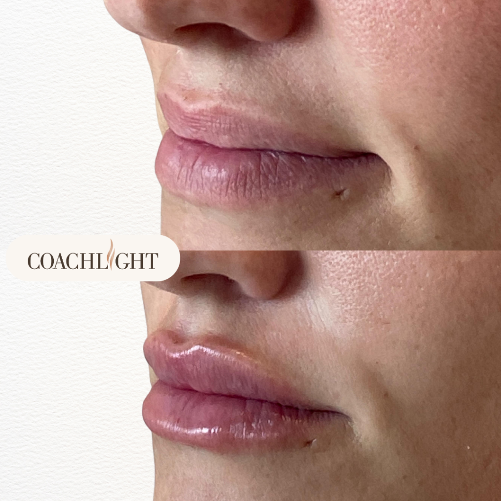 Lip Filler Treatments 6 Lip Filler