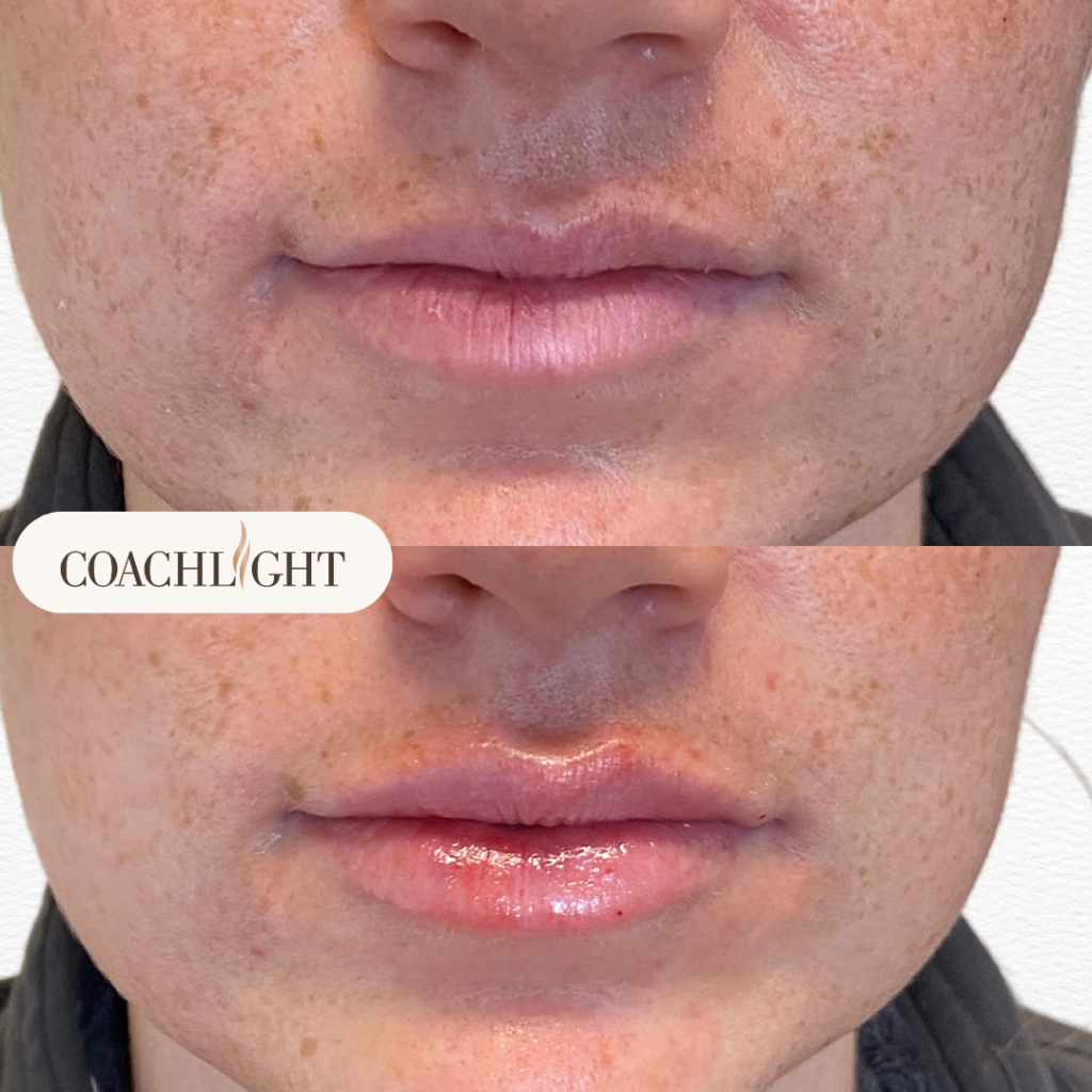 Lip Filler Treatments 7 Lip Filler