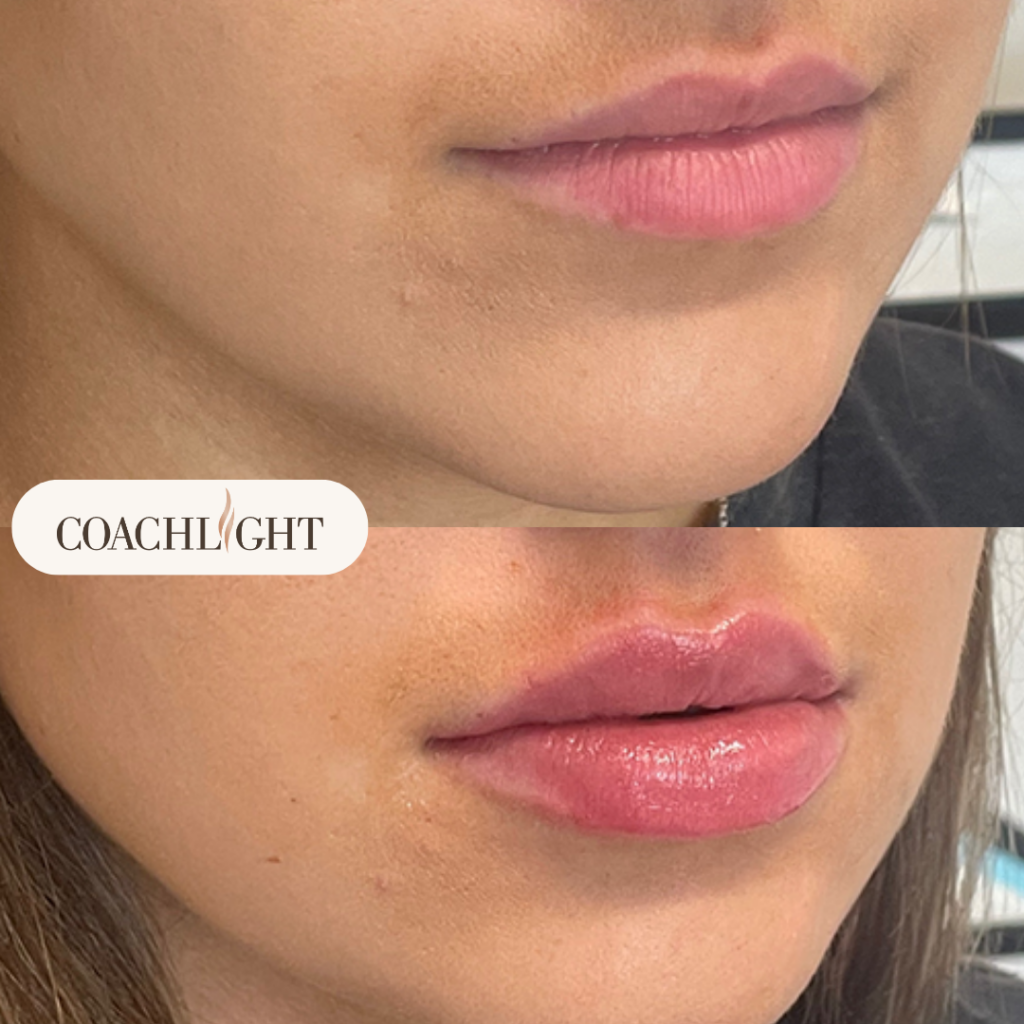Lip Filler Treatments 5 Lip Filler