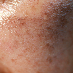 Moxi Laser Treatment 9 Pigmentation