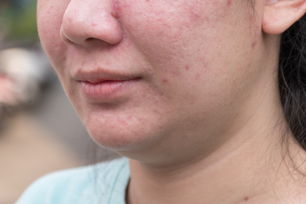 Moxi Laser Treatment 11 Acne